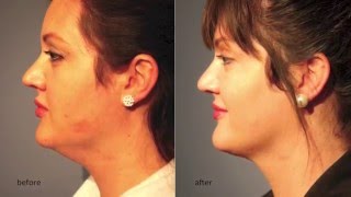 Kybella Injection for Elimination of the quotDouble Chinquot [upl. by Tiebout]