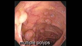 Colonoscopy FollowUp of Colon Polyp  Los Angeles Colonoscopy [upl. by Seldon959]