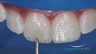 Aumento Incisal com Resinas Compostas  Leonardo Muniz [upl. by Harwilll]