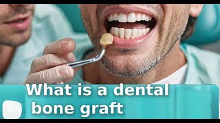 What is a dental bone graft [upl. by Halda]