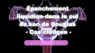 Épanchement liquidien dans le cul de sac de Douglas  Cas clinique [upl. by Lagiba]