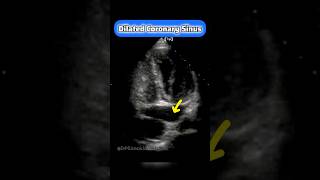 Coronary Sinus on Echocardiography echocardiogram cardiology echo [upl. by Coward]