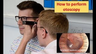 How to perform Otoscopy Ear Exam [upl. by Lizzy516]