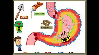 HELICOBACTER PYLORI GASTRITIS [upl. by Langille]