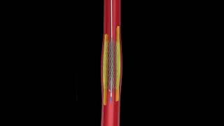 Angioplasty amp Heart Blockage Explained in Animation [upl. by Iain]