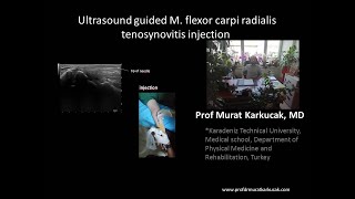 Ultrasound guided M flexor carpi radialis tenosynovitis injection by Prof Murat Karkucak MD [upl. by Ahsenwahs]