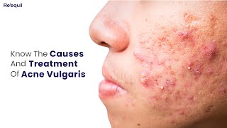 Causes And Treatment Of Acne Vulgaris [upl. by Colleen]