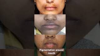 Pigmentation around mouth pigmentation pigmentationremoval [upl. by Anigriv557]