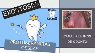 Exostose  Resumos de Odonto [upl. by Nogem]