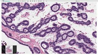 Canalicular Adenoma  Salivary Gland Histopathology [upl. by Rennob]