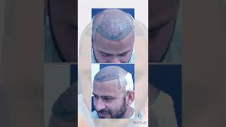 Best Hair Transplant In Pune hairtransplant hairtransplantbeforeandafter [upl. by Daye]