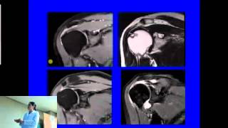 Resonancia Magnética Nuclear en Hombro [upl. by Kyrstin]
