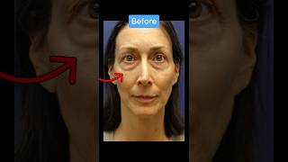 Insane Face Transformation BEFORE AFTER blepharoplasty [upl. by Japheth]