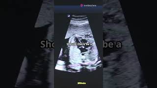 Understanding Fetal Heart Rates Key Insights [upl. by Eillom]