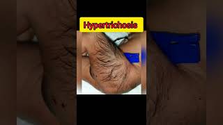 HypertrichosisExcessive hairiness [upl. by Pollyanna]