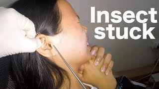 Removing INSECT Stuck in Womans Ear [upl. by Auohc]