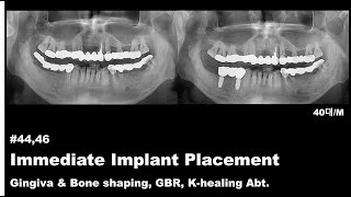 4446 Immediate Implant Placement Gingiva amp Bone shaping GBR Khealing Abt [upl. by Arlinda]