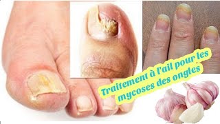 traitement mycose des ongles [upl. by Flori]