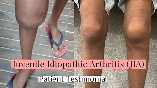 Juvenile Idiopathic Arthritis amp Homoeopathy  Patient Testimonial  Dr Vidur Vithal MD arthritis [upl. by Ahsilak]