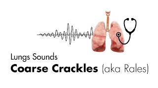 Coarse Crackles Rales  Lung Sounds  Medzcool [upl. by Anelrac]