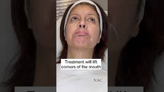 Botox Injection for Downturned Mouth botox antiaging antiwrinkle daobotox daomuscle [upl. by Abana110]