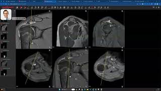 Lipoma arborescens in the subdeltoid bursa [upl. by Wahl]