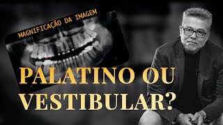 Como descobrir se o canino está por palatino ou vestibular 🤔 [upl. by Vasos508]