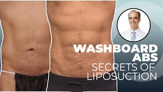 Liposuction for Guys How to get rid of love handles and get a sixpack [upl. by Norehc]