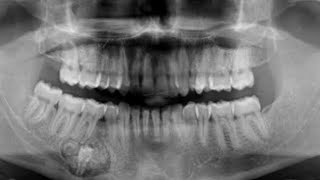 Calcifying Epithelial Odontogenic Tumor Pindborg tumor  III BDS Oral Pathology  RGUHS [upl. by Uyerta524]