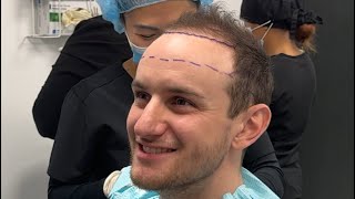 How to decide Hair transplant hairline height [upl. by Netsyrc]