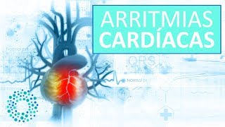 ARRITMIAS CARDIACAS – Síntomas y Tratamientos Arritmias [upl. by Rust]