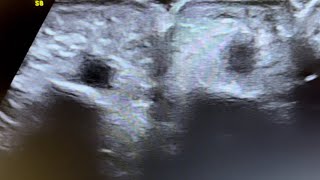 Ultrasound of tenosynovitis of flexir tendons of hand [upl. by Sandie713]