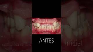 Implantes dentales  Antes y después [upl. by Pepper]