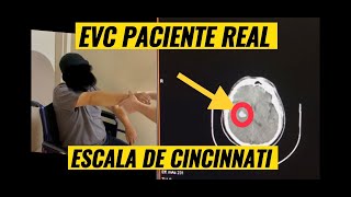 EVC caso clinico  Escala de Cincinnati [upl. by Drannel]