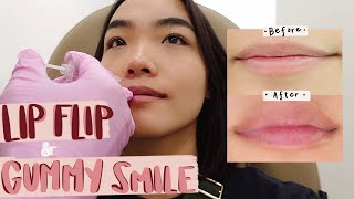 getting my lips done  lip flip  gummy smile transformation [upl. by Swann]