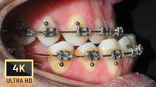 UNDERBITE in adults❗Braces time lapse [upl. by Quincey]