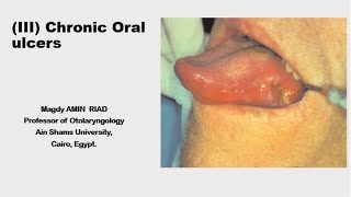 III Chronic Oral Ulcers [upl. by Ylesara]