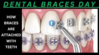 DENTAL BRACES PLACEMENT  HOW DENTAL BRACKET AND WIRES ARE PLACED FOR ORTHODONTIC TREATMENT [upl. by Notserp]