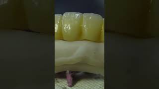 Coronas y carillas de Zirconio impresión dental en 3d odontologia ecuador art guayaquil [upl. by Karlan]