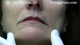 Botox Injection to DAO corner of mouth by Dr Joe Niamtu III [upl. by Annaul406]