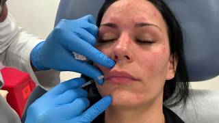 Nonsurgical lip lift using Botox or Dysport by Dr Shaun Patel in Miami FL  Botox Lip Flip [upl. by Bergstrom]