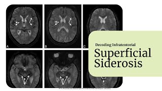 Decoding Superficial Siderosis [upl. by Creedon128]