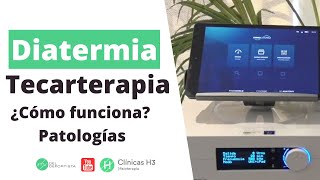 ¿Qué es la tecarterapia Patologías indicadas ✅ Diatermia Madrid Clínicas H3 [upl. by Wedurn]