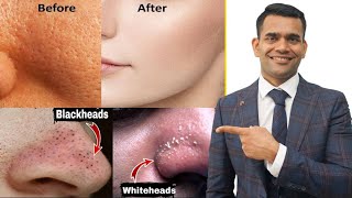 Blackheads Whiteheads Open Pores 100  Working Home Remedy  How To Shrink Pores [upl. by Tri]