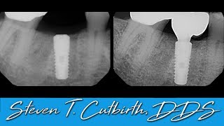 Implant Impression Abutment and Crown Seating  Dental Minute with Steven T Cutbirth DDS [upl. by Paymar]