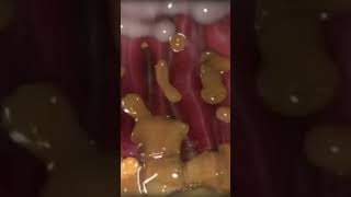 Gastric ulcer [upl. by Adnol]