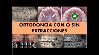 quotORTODONCIA CON O SIN EXTRACCIONES INDICACIONESquot [upl. by Bortz]