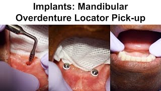 2 Implants Mandibular Overdenture Locator Pickup [upl. by Suqram]