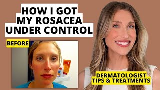 My Rosacea Journey Dermatologist Shares Skincare amp Treatments That Work  Dr Sam Ellis [upl. by Robillard238]