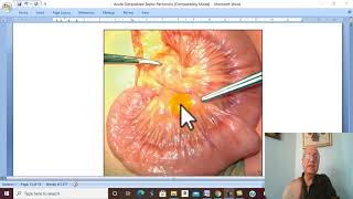 Peritoneal Disorders in Arabic 4 Acute Non Specific Mesenteric Lymphadenitis   by Dr Wahdan [upl. by Leuqim]